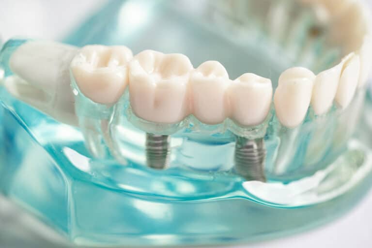 Dental model of the lower jaw with two implants supporting a dental bridge.
