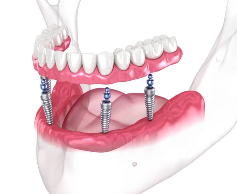 Lower jaw with three dental implants and blue abutments supporting a removable overdenture; upper denture is visible above.