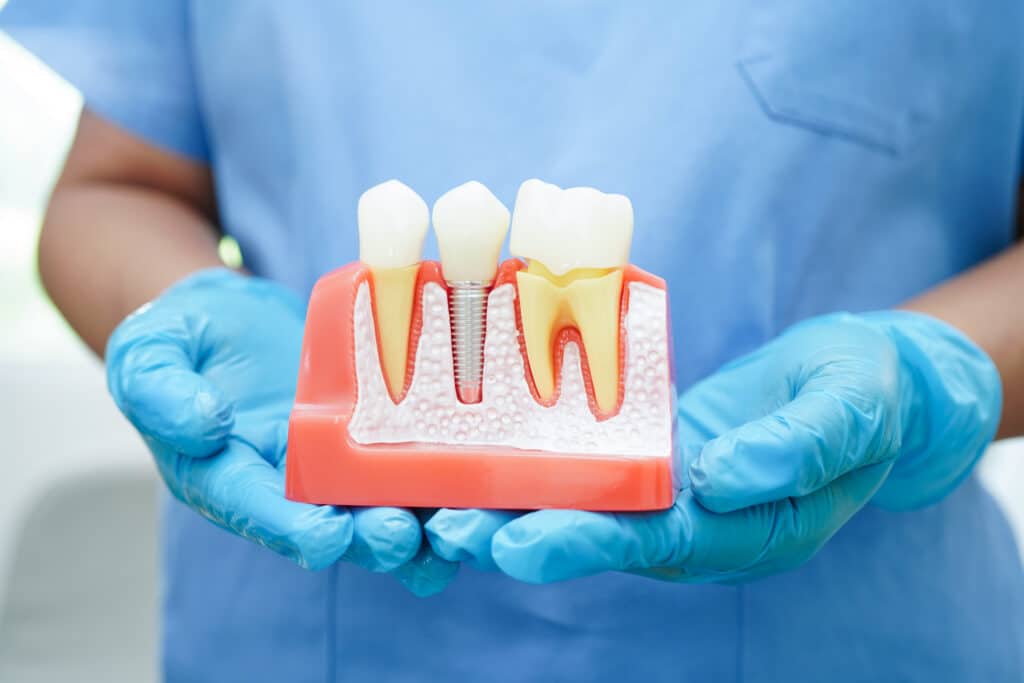 Dental implant model showing a screw-type implant in the jaw between two natural teeth, held by gloved hands.