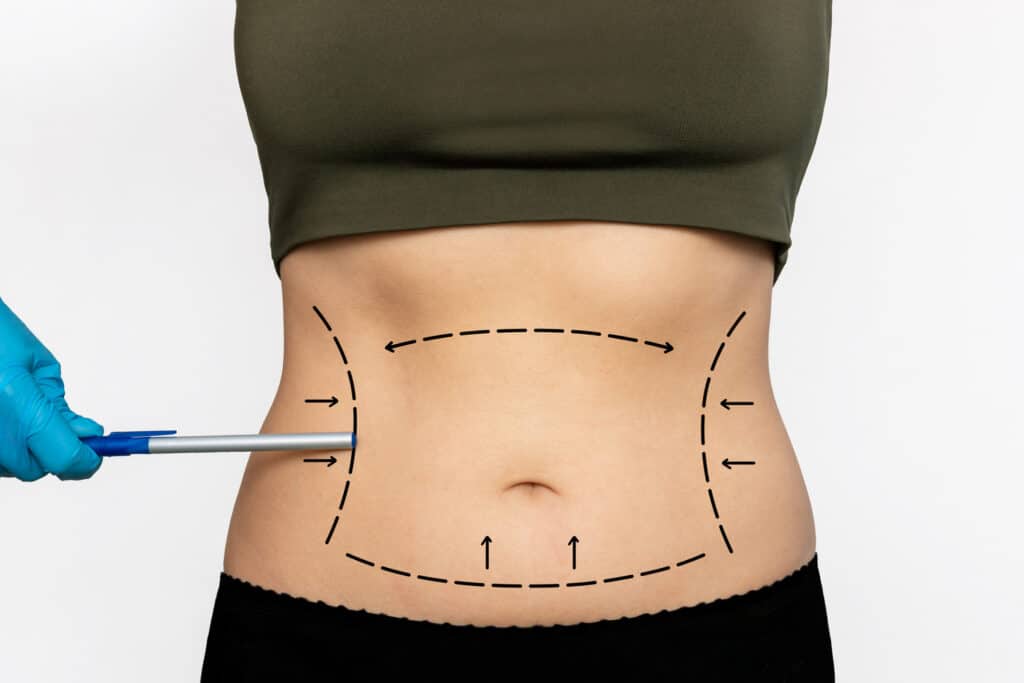 Back view of a person’s midsection with surgical dashed lines outlining a contour area on the abdomen; a gloved hand holds a marker pen near the left side.