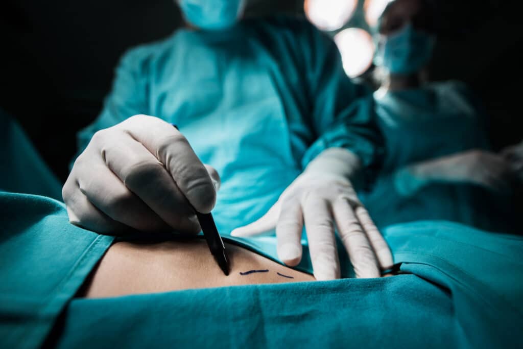 Surgical team in teal scrubs and gloves, performing an operation with a surgeon's hand drawing a mark on the patient’s skin.